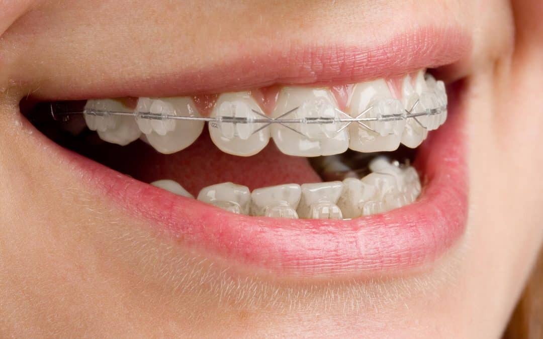 What causes crooked teeth?