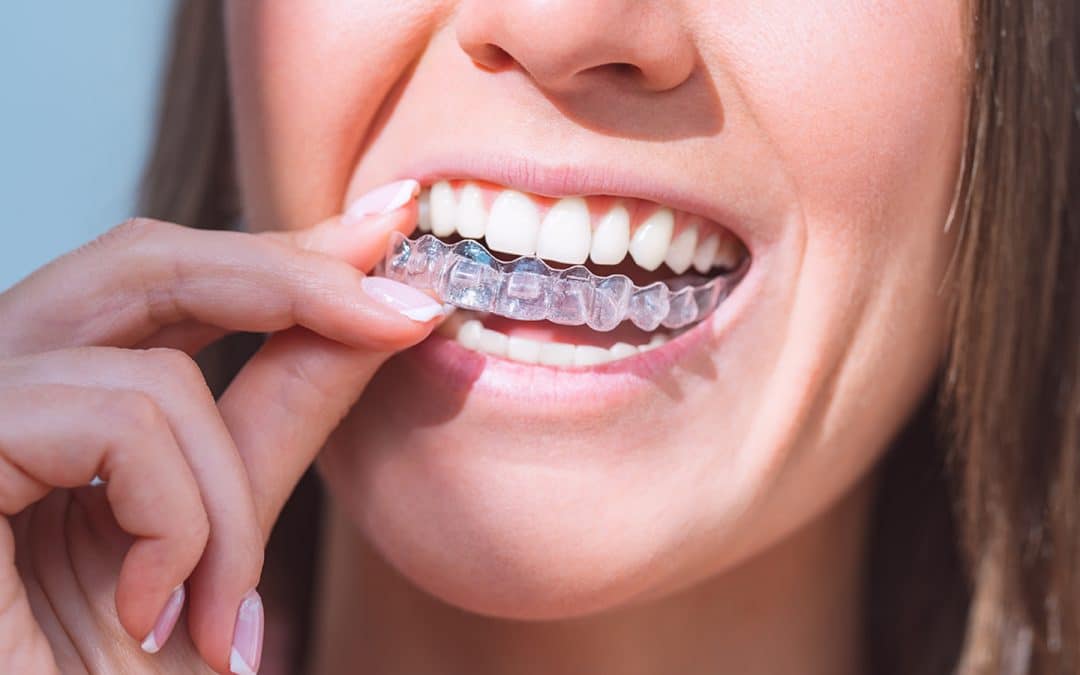 Clear Aligners Compared to Traditional Braces